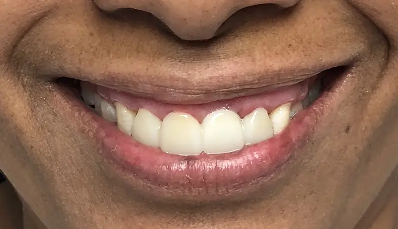 Dental Bridge Cases 5